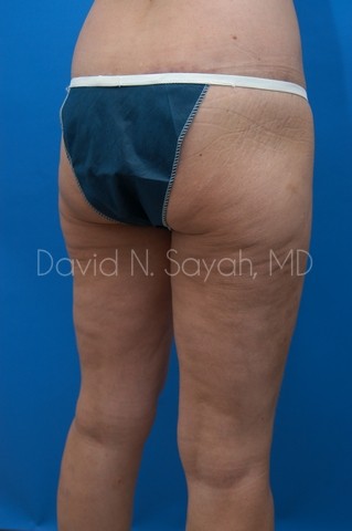 Thigh Lift Before and After | Sayah Institute