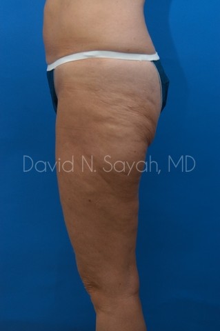 Thigh Lift Before and After | Sayah Institute