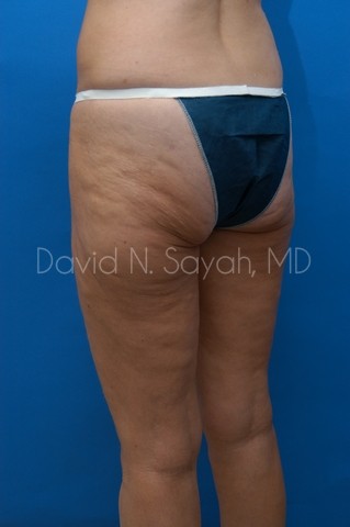 Thigh Lift Before and After | Sayah Institute