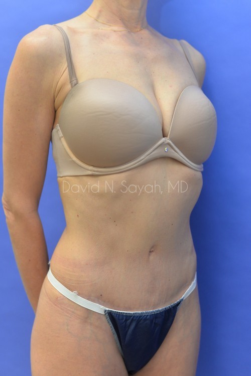 Tummy Tuck Before and After | Sayah Institute