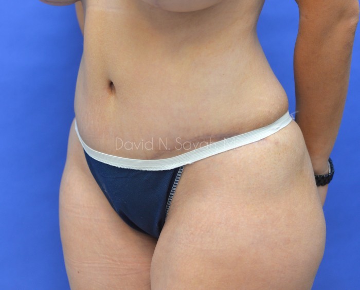 Tummy Tuck Before and After | Sayah Institute