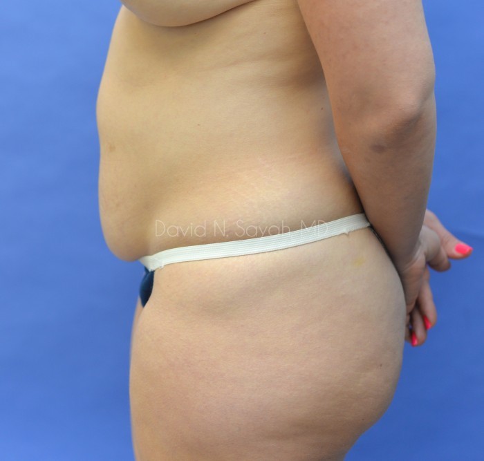 Tummy Tuck Before and After | Sayah Institute