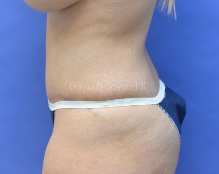 Tummy Tuck Before and After | Sayah Institute