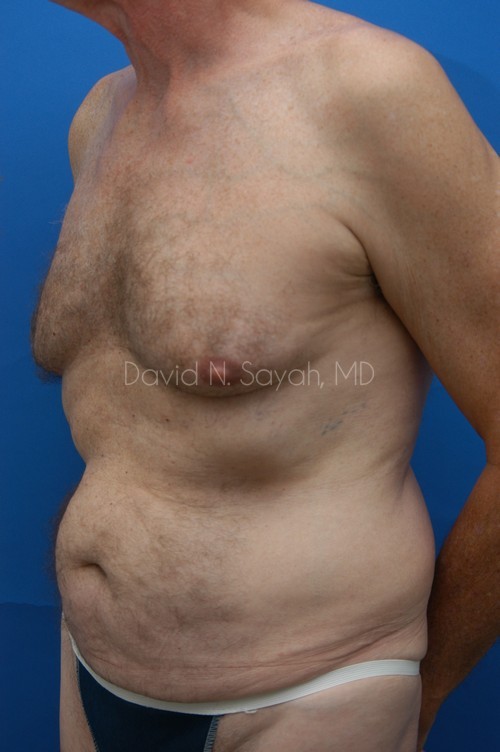 Tummy Tuck Before and After | Sayah Institute