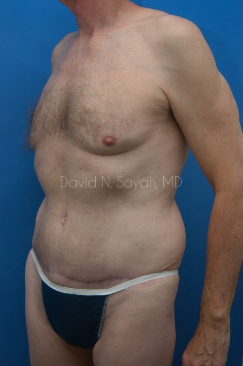 Tummy Tuck Before and After | Sayah Institute