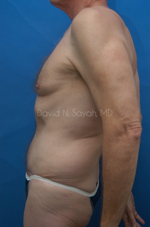 Tummy Tuck Before and After | Sayah Institute