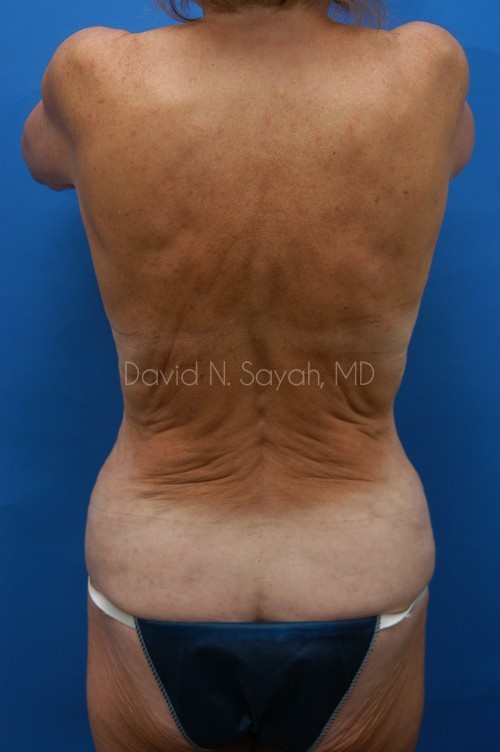 Tummy Tuck Before and After | Sayah Institute