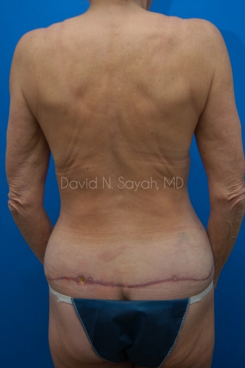 Tummy Tuck Before and After | Sayah Institute