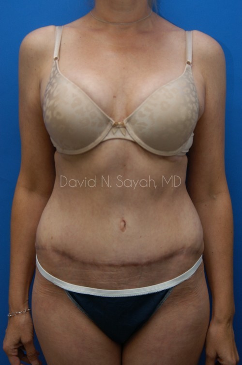 Tummy Tuck Before and After | Sayah Institute