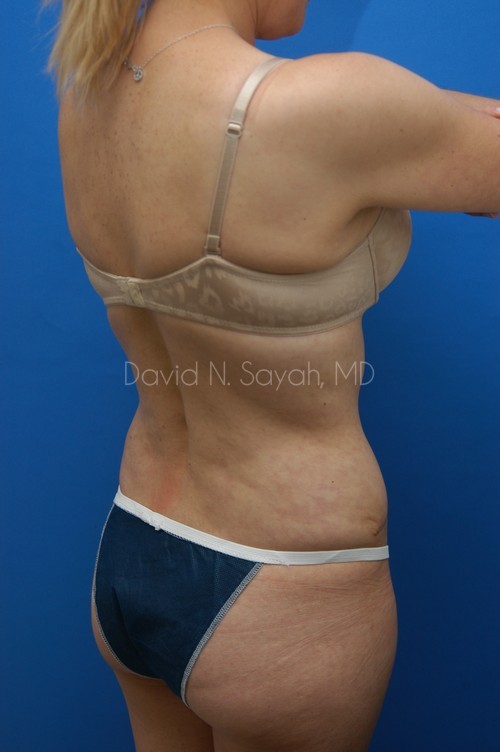 Tummy Tuck Before and After | Sayah Institute