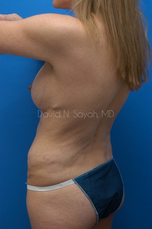 Tummy Tuck Before and After | Sayah Institute