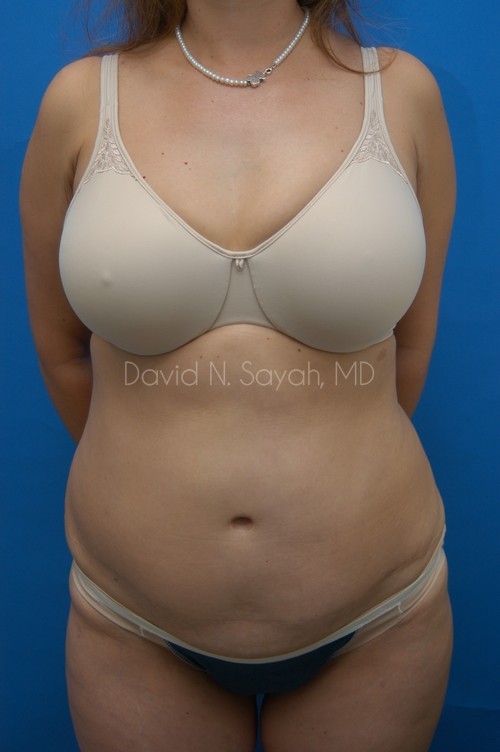 Tummy Tuck Before and After | Sayah Institute