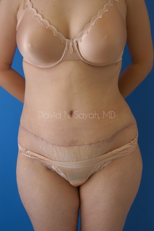 Tummy Tuck Before and After | Sayah Institute