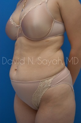 Tummy Tuck Before and After | Sayah Institute