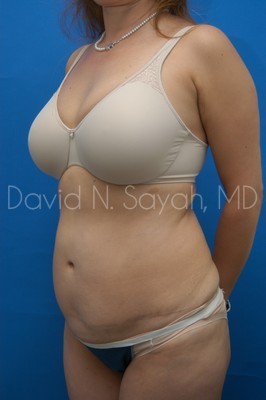 Tummy Tuck Before and After | Sayah Institute