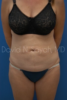 Tummy Tuck Before and After | Sayah Institute