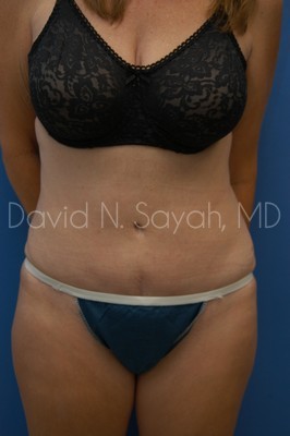 Tummy Tuck Before and After | Sayah Institute