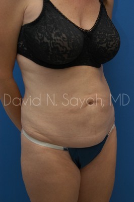 Tummy Tuck Before and After | Sayah Institute