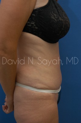 Tummy Tuck Before and After | Sayah Institute