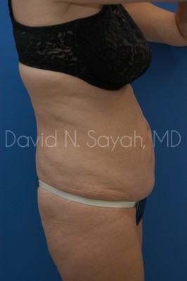 Tummy Tuck Before and After | Sayah Institute