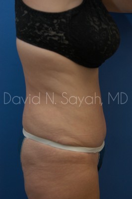 Tummy Tuck Before and After | Sayah Institute