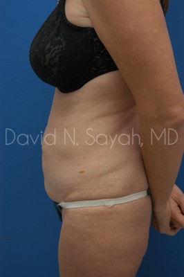 Tummy Tuck Before and After | Sayah Institute