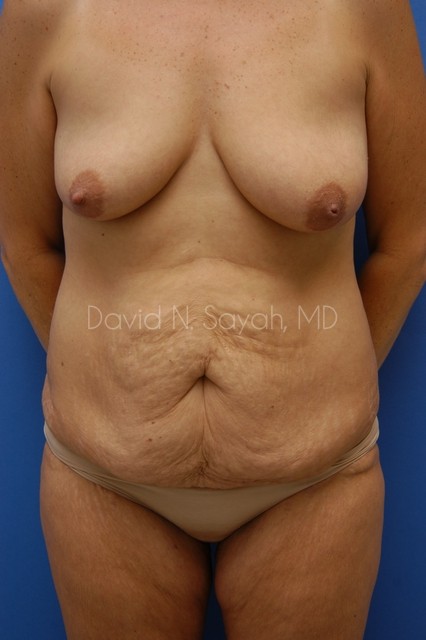 Tummy Tuck Before and After | Sayah Institute