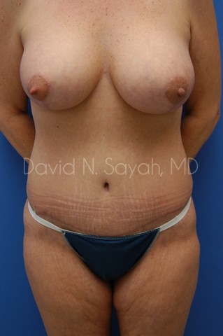 Tummy Tuck Before and After | Sayah Institute