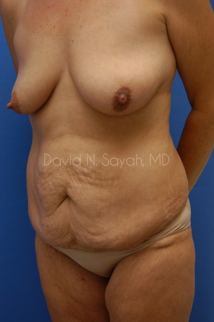 Tummy Tuck Before and After | Sayah Institute