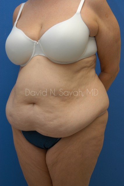 Tummy Tuck Before and After | Sayah Institute