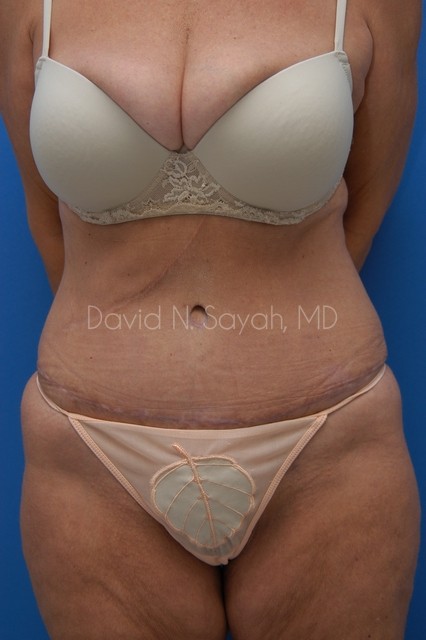 Tummy Tuck Before and After | Sayah Institute