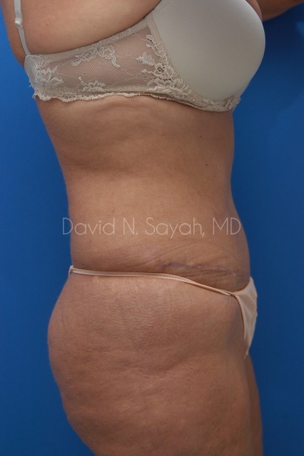 Tummy Tuck Before and After | Sayah Institute