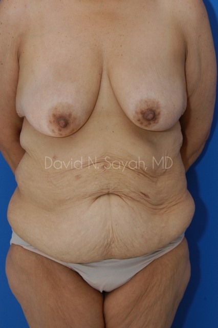 Tummy Tuck Before and After | Sayah Institute