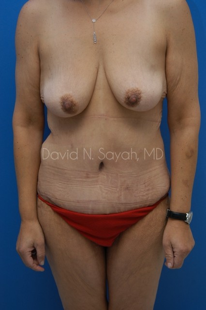 Tummy Tuck Before and After | Sayah Institute