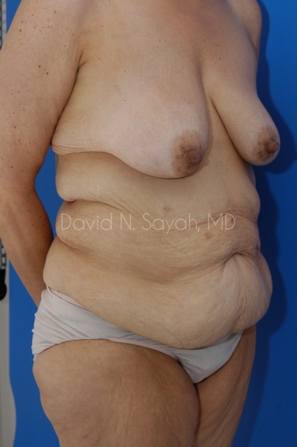 Tummy Tuck Before and After | Sayah Institute