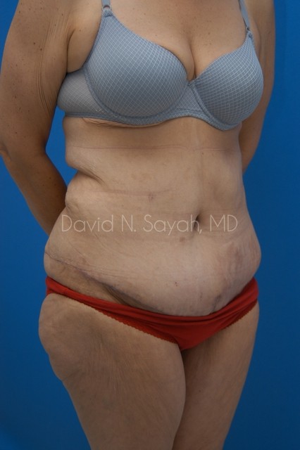 Tummy Tuck Before and After | Sayah Institute