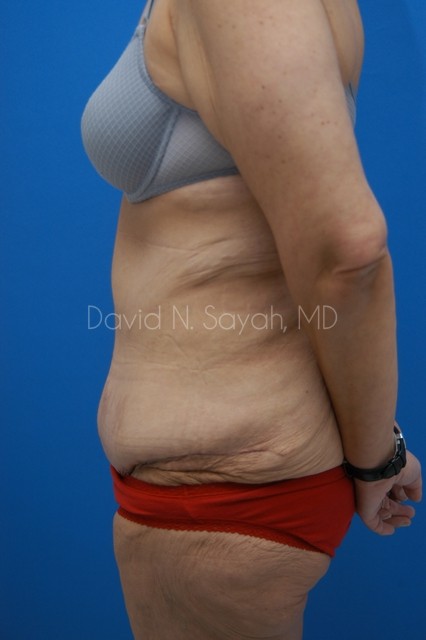 Tummy Tuck Before and After | Sayah Institute