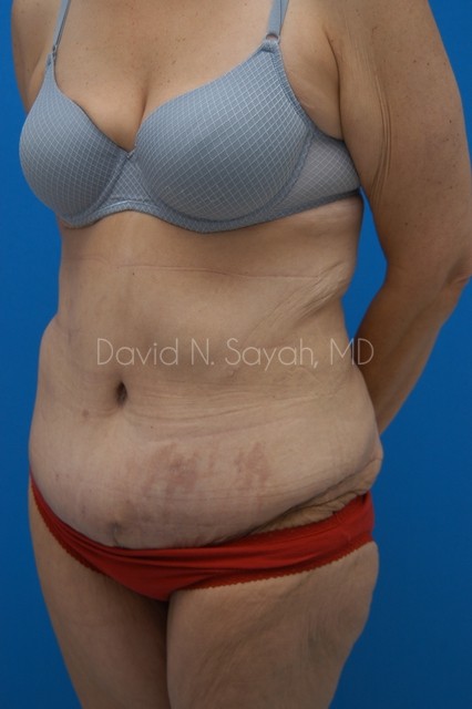 Tummy Tuck Before and After | Sayah Institute