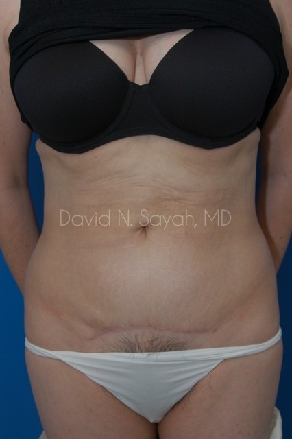 Tummy Tuck Before and After | Sayah Institute