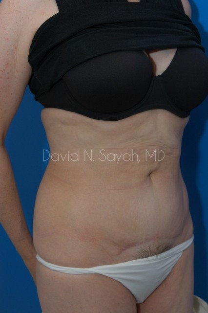 Tummy Tuck Before and After | Sayah Institute