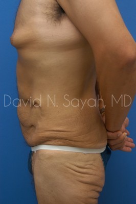 Tummy Tuck Before and After | Sayah Institute