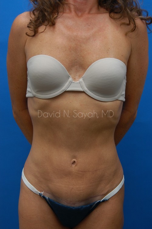 Tummy Tuck Before and After | Sayah Institute