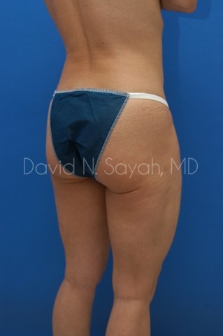 Tummy Tuck Before and After | Sayah Institute