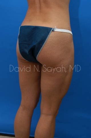 Tummy Tuck Before and After | Sayah Institute