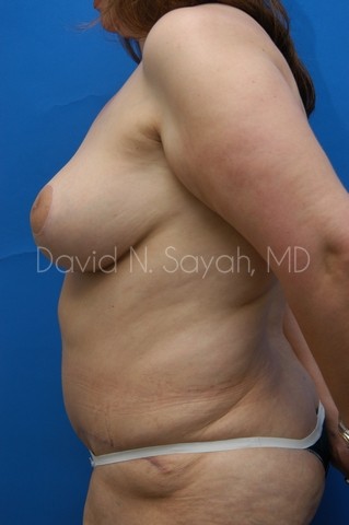 Tummy Tuck Before and After | Sayah Institute