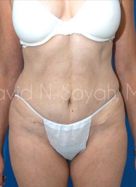 Tummy Tuck Before and After | Sayah Institute