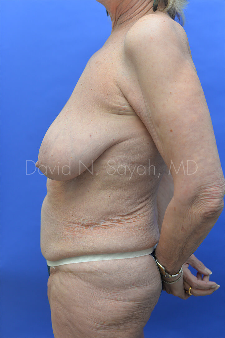 Tummy Tuck Before and After | Sayah Institute