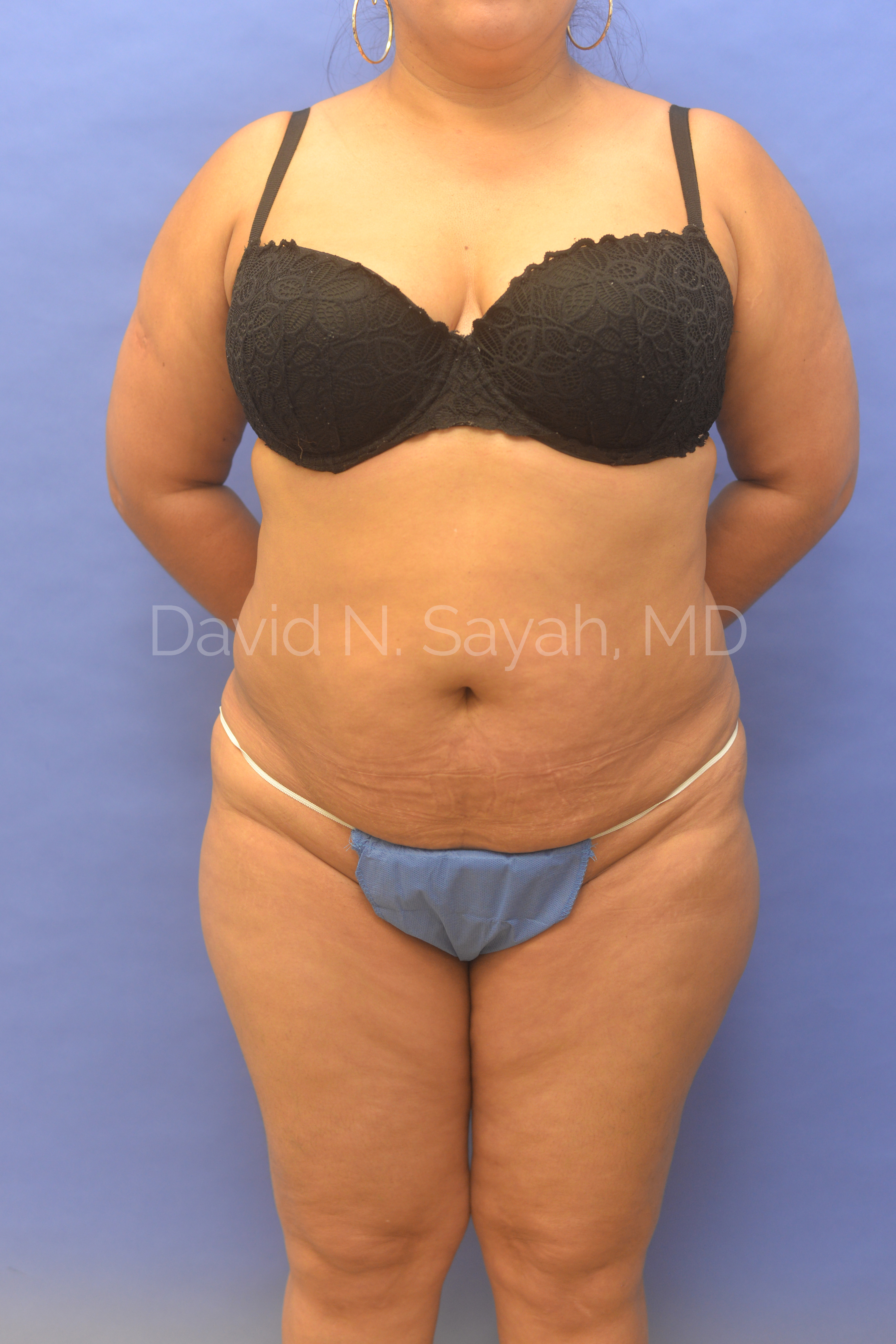 Tummy Tuck Before and After | Sayah Institute