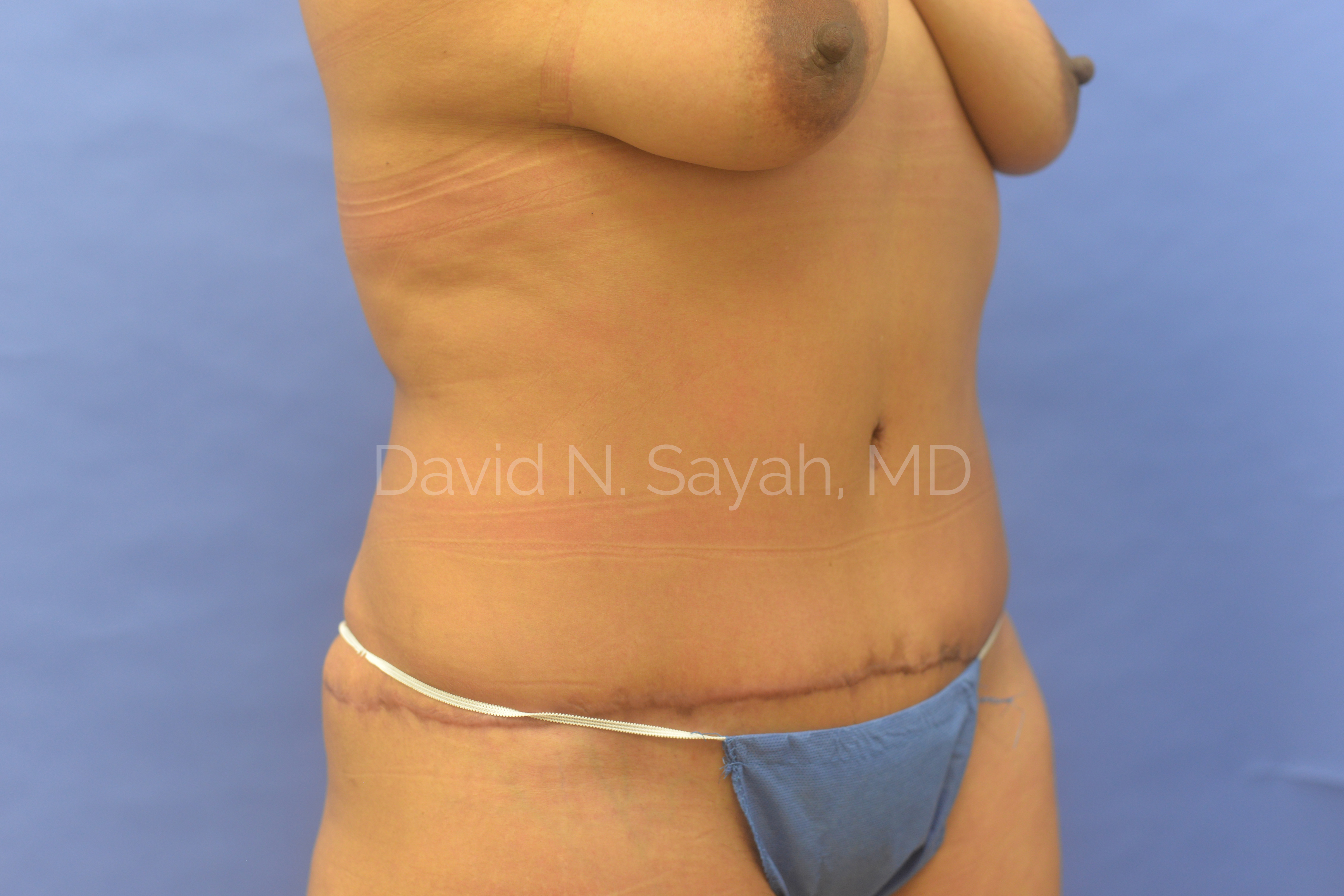 Tummy Tuck Before and After | Sayah Institute