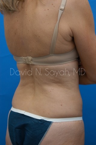 Back Tuck Belt Lipectomy Before and After | Sayah Institute